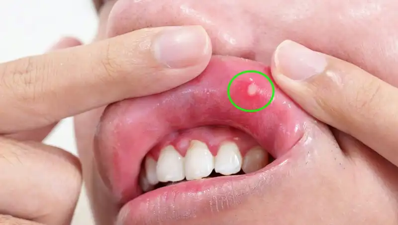 B Vitamini Eksikliği: Dikkat Etmeniz Gereken 5 Belirgin Belirti