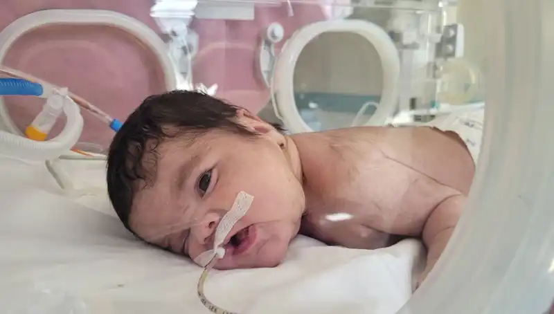 34 Haftalık Eymen Bebek, Dünyada 7. Vaka Olarak Hayata Tutundu