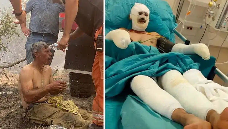 Yangında Yaralanan Orman İşçisinin Sağlık Durumu ve Tedavi Süreci